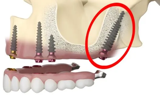 Pterygoid implants