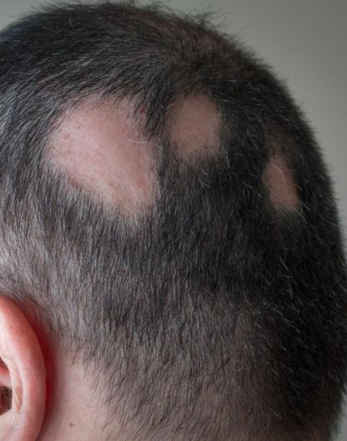 Alopecia