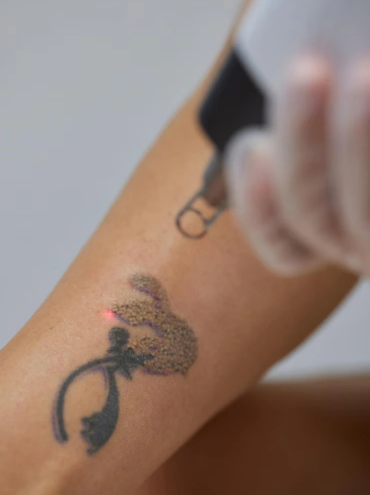 Tattoo Removal