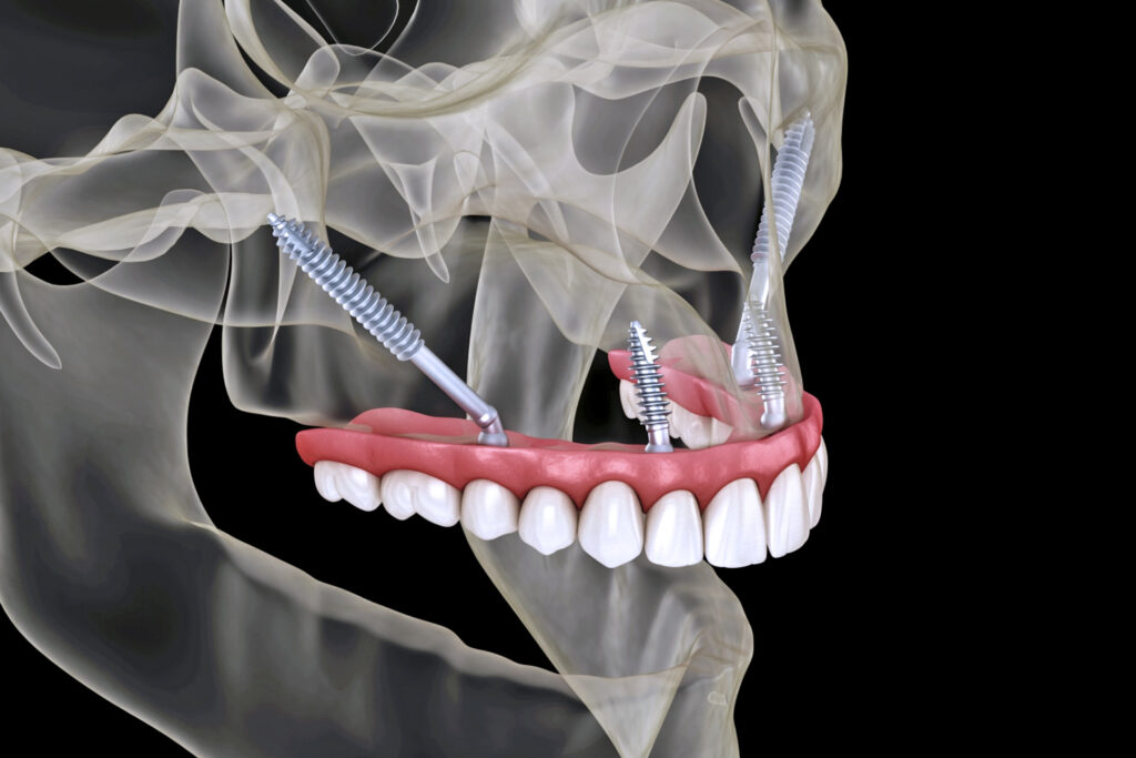 Zygomatic dental implants
