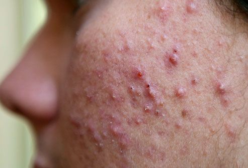 Acne Treatment in Hinjewadi