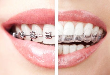 Dental braces in Hinjewadi