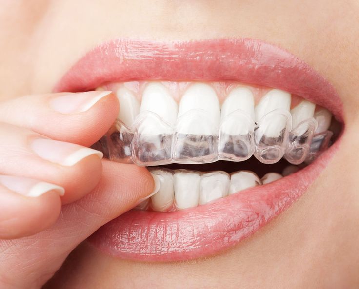 Best Clear Aligners