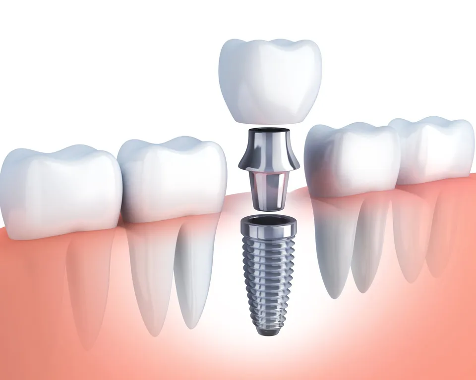 Conventional dental implants