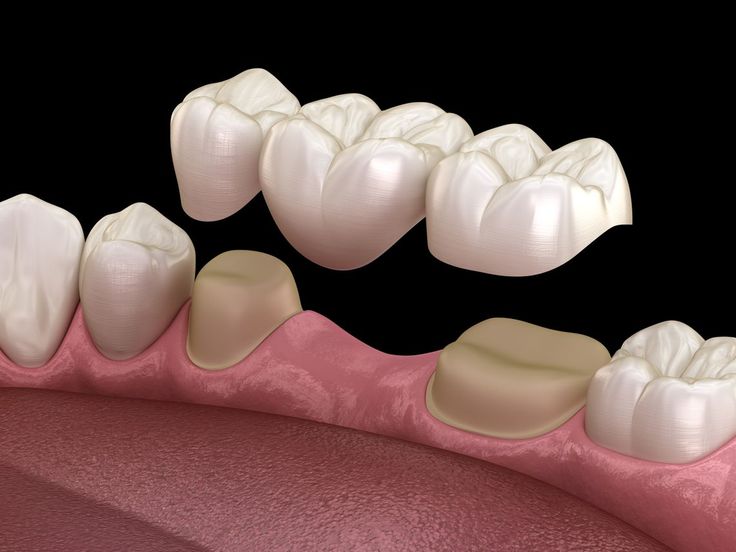 Find Crowns & bridges treatment in hinjewadi