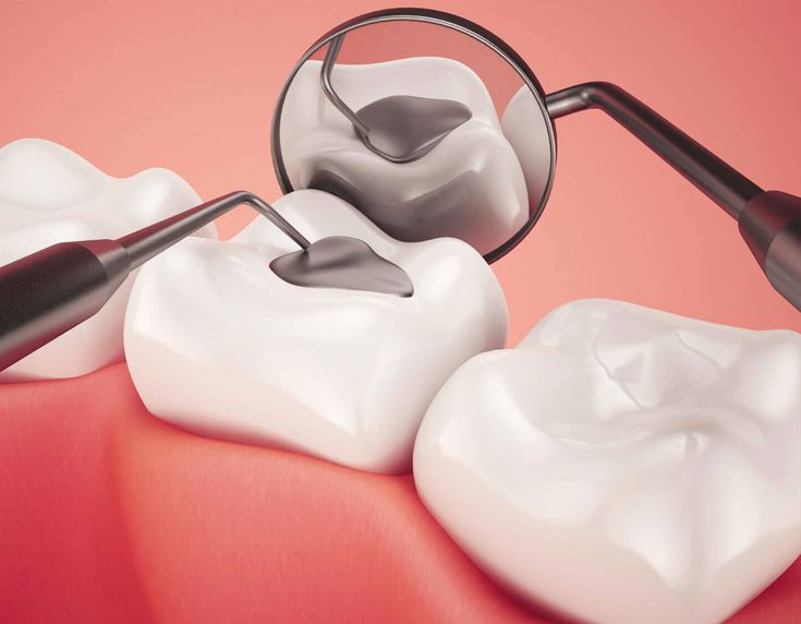 Get Dental filling in hinjewadi