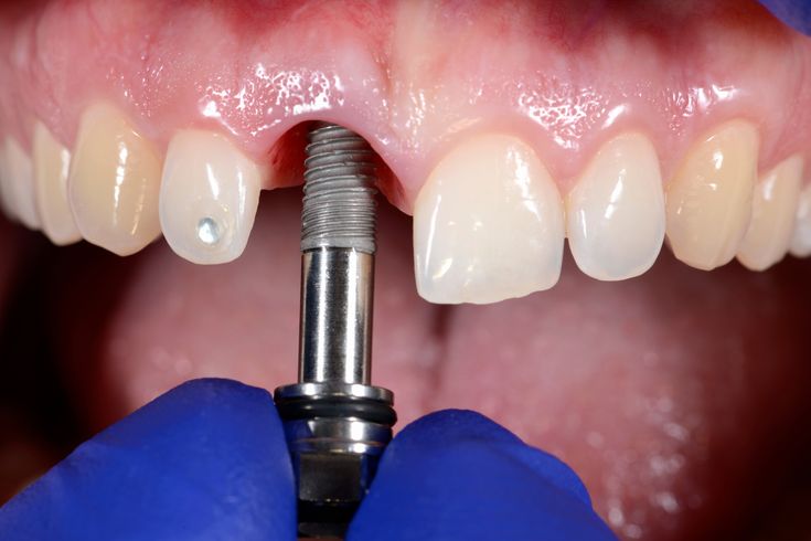 Dental Implant