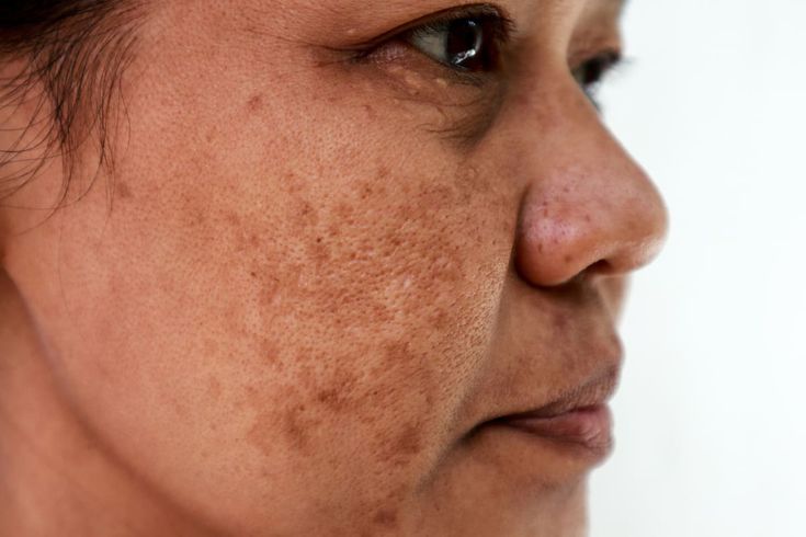 Hyperpigmentation Treatment in Hinjewadi