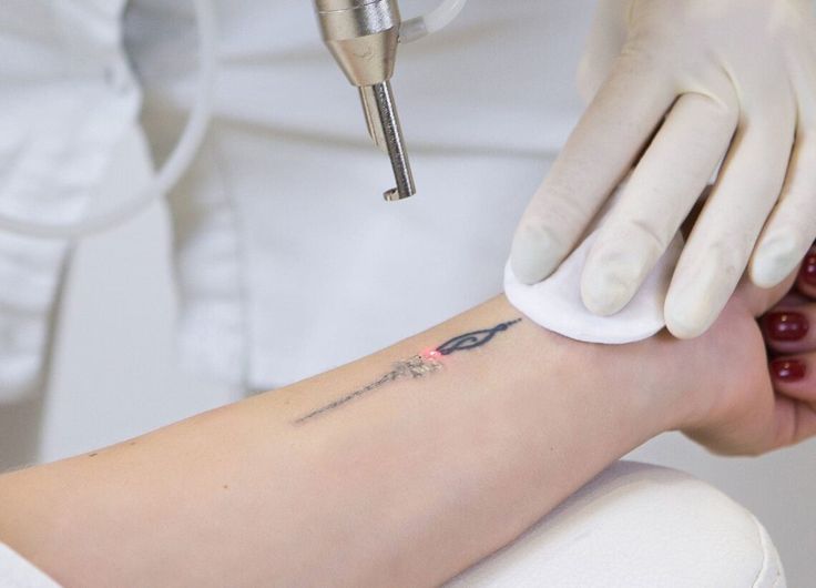 Tattoo Removal in Hinjewadi