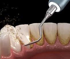 Teeth Cleaning/ Whitening 