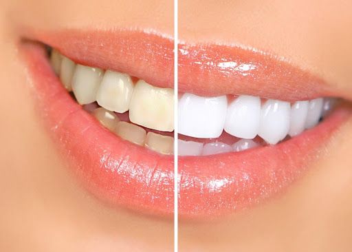 Best Teeth Whitening Treatment in Hinjewadi