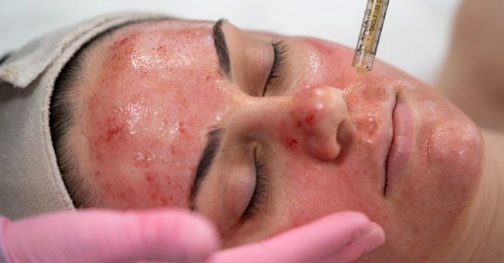 Vampire Facial in Hinjewadi