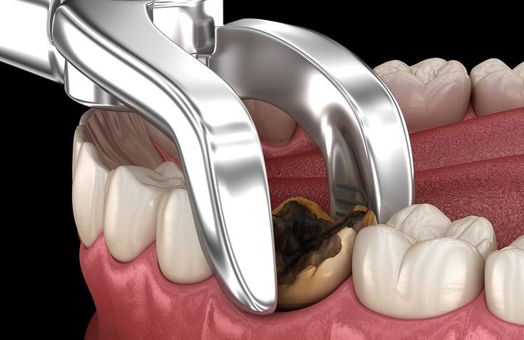 Wisdom Tooth Removal Treatment
