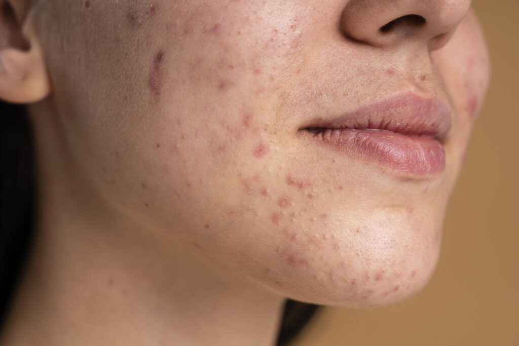 Acne Treatment in Hinjewadi