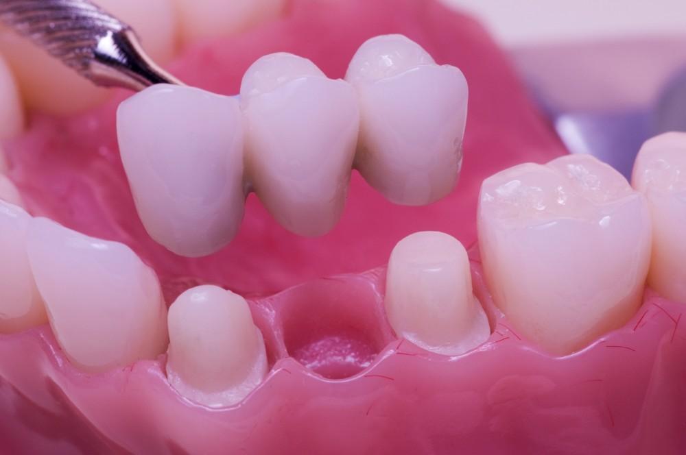 Get Crown & Bridge Treatment in Hinjewadi