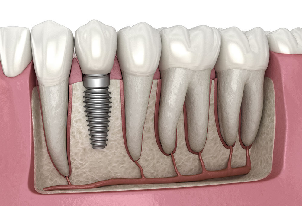 Dental implants in Hinjewadi