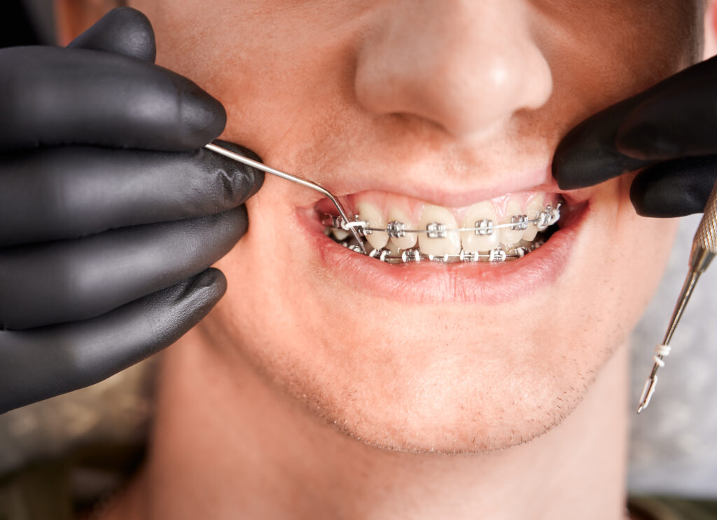 Orthodontic treatment in Hinjewadi