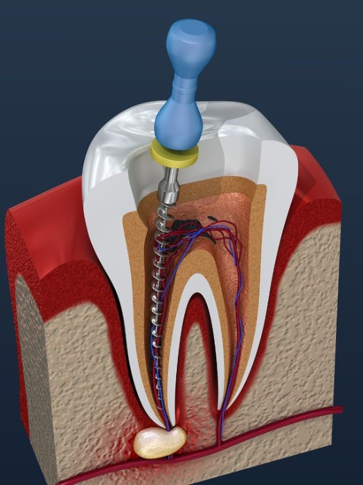 Root Canal Treatment Near Hinjewadi