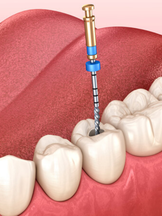 Root Canal Treatment in Hinjewadi