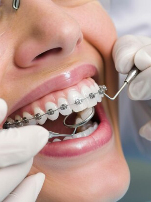 Best Orthodontic treatment in Hinjewadi