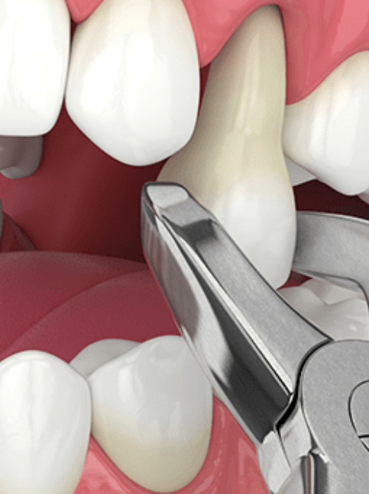 Best Tooth Extraction Treatment in Hinjewadi