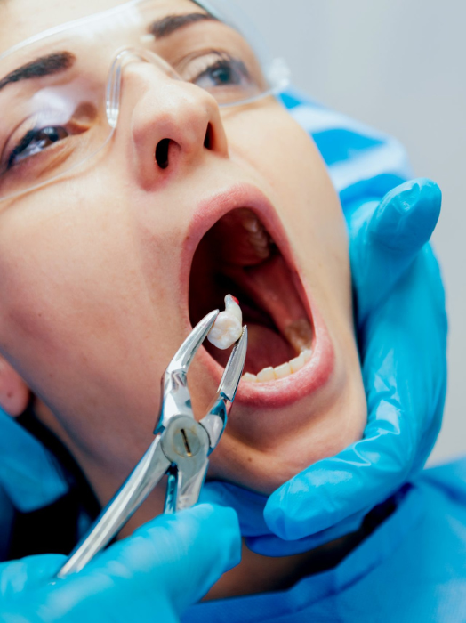 Tooth Extraction Treatment in Hinjewadi