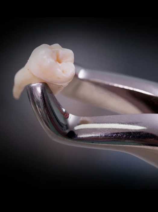 Best Wisdom Tooth Removal Treatment in Hinjewadi