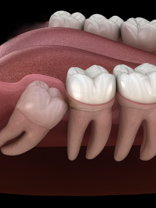 Wisdom Tooth Removal Treatment in Hinjewadi