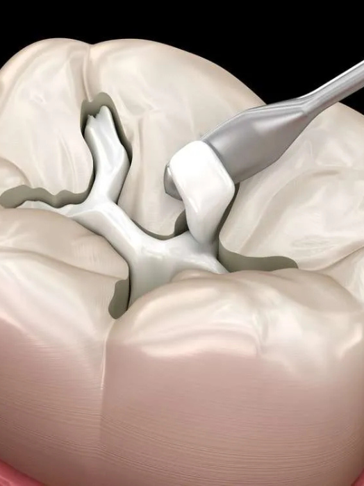 Best Dental Filling Treatment in Hinjewadi