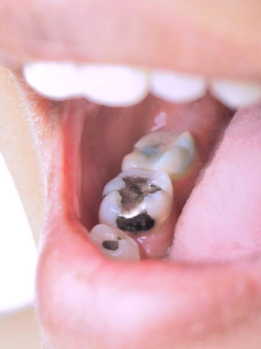 Dental Filling Treatment in Hinjewadi