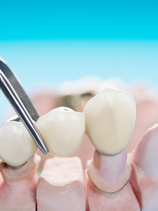 Find Crown & Bridge Treatment in Hinjewadi