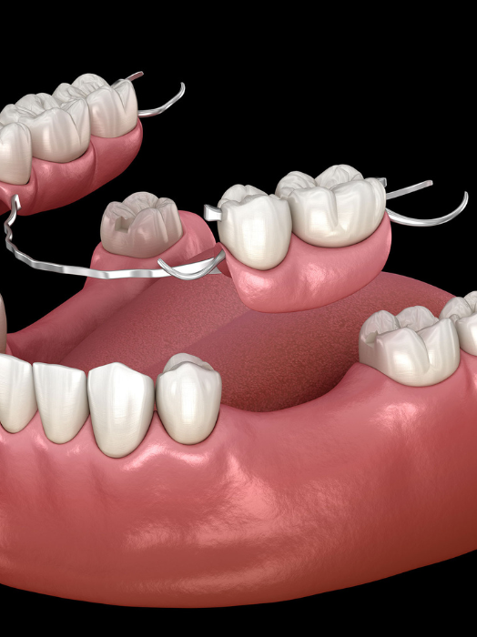Best Denture Treatment in Hinjewadi