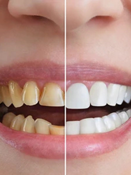 Teeth Whitening Treatment in Hinjewadi