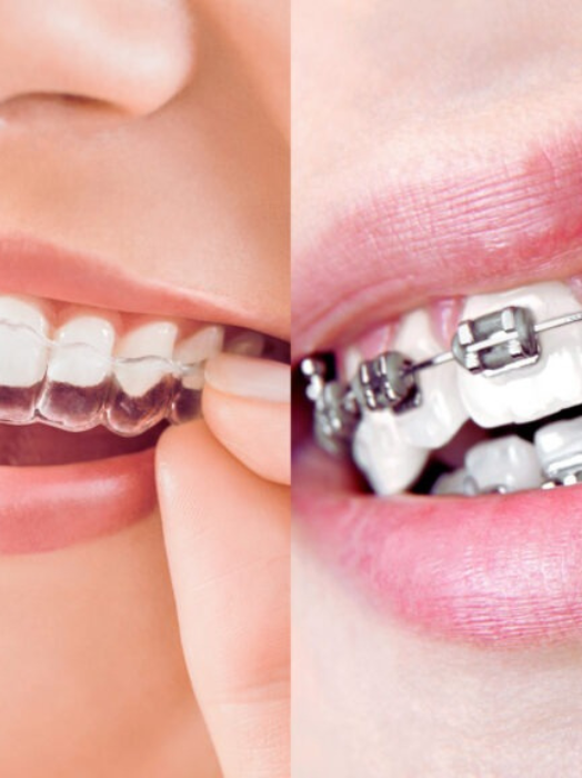 Orthodontic Treatment in Hinjewadi