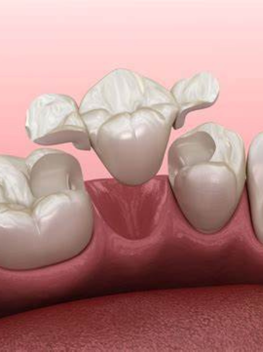 Crown & Bridge Treatment in Hinjewadi