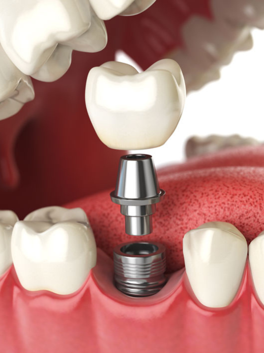 Best Dental Implant in Hinjewadi