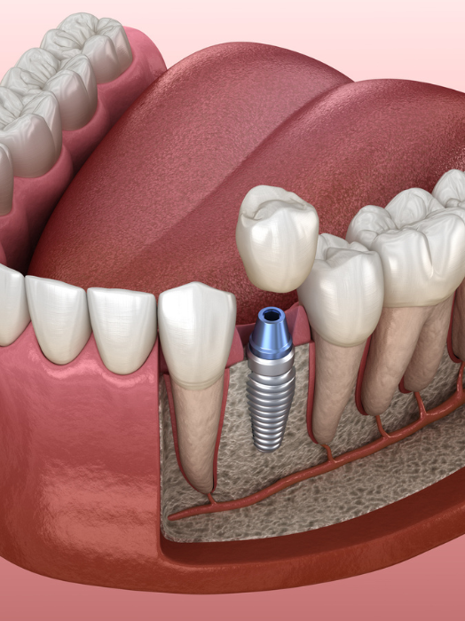 Dental Implant Treatment in Hinjewadi