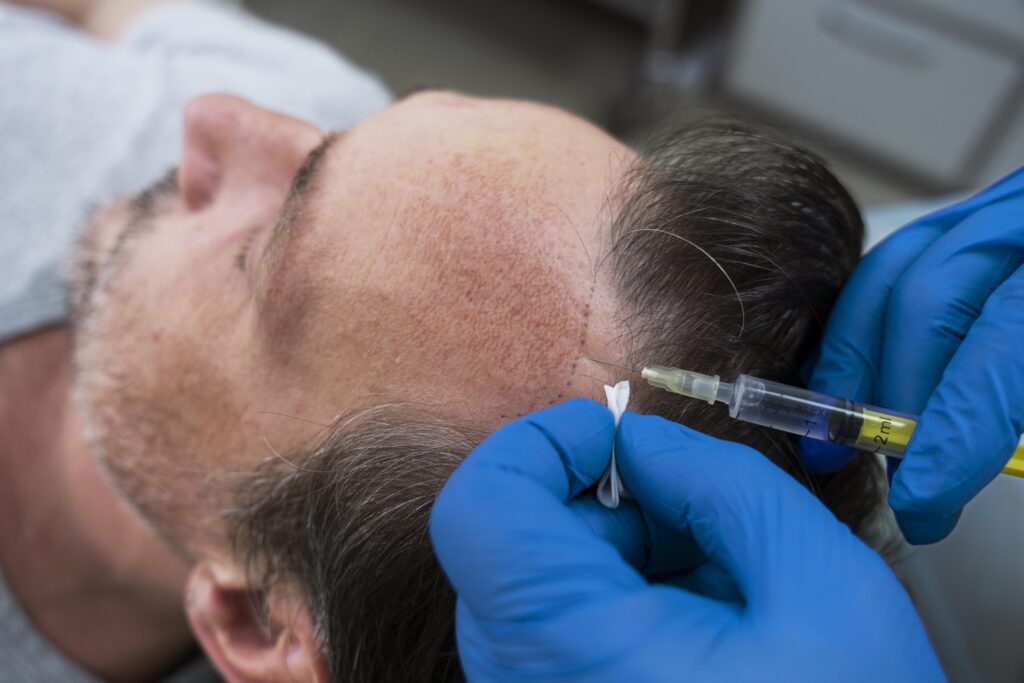 Hair Transplant treatment in Hinjewadi