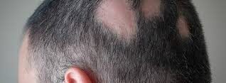 Alopecia Treatment in Hinjewadi