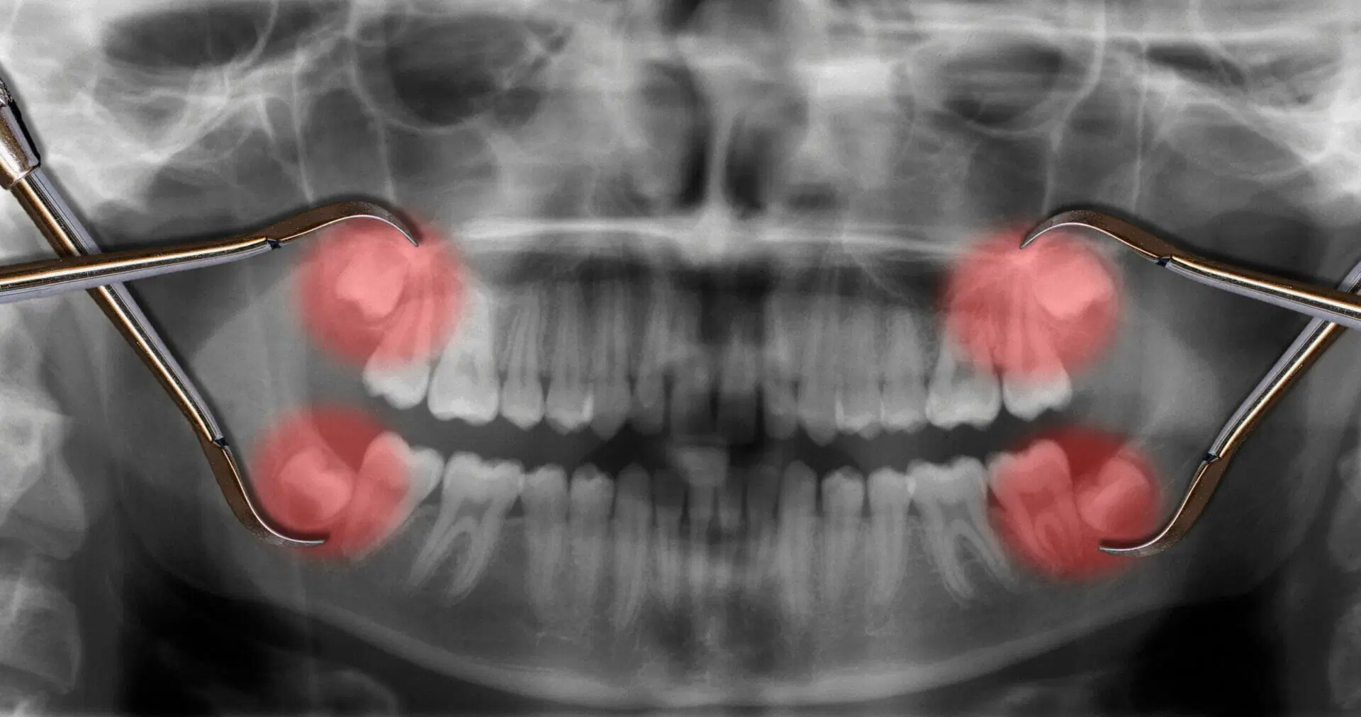 Get Wisdom Tooth Removal Treatment in Hinjewadi