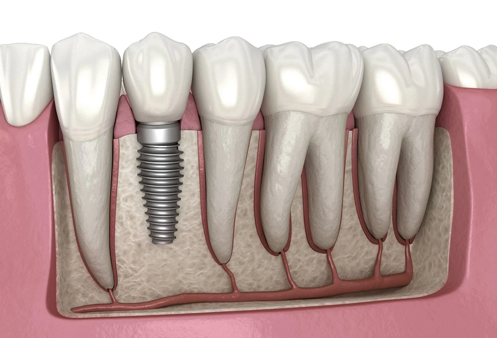 Dental-implant in Hinjewadi